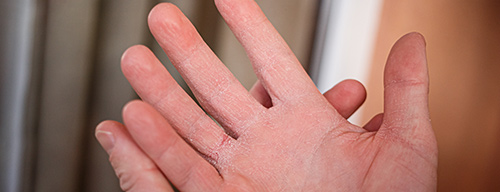 Lutter contre les mains sèches l'hiver